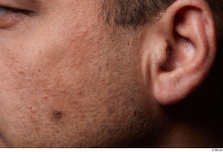HD Face Skin Hudhaifa Jabour birthmarks cheek ear face hair…